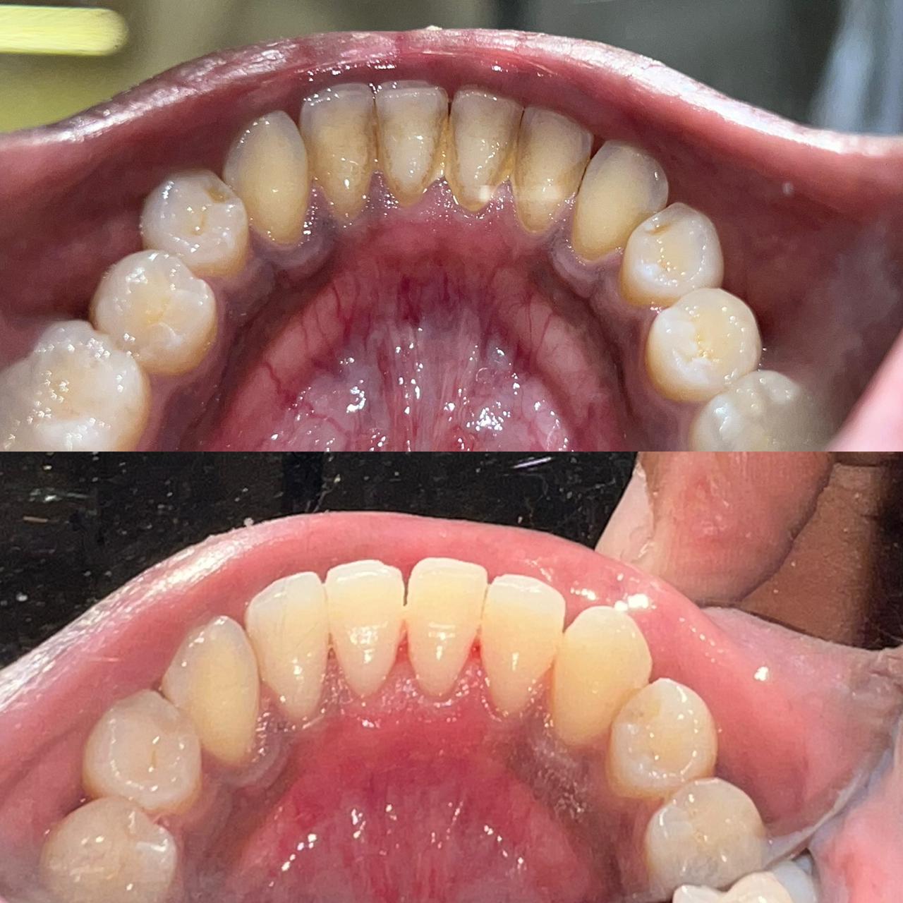 Before Clear Aligners Treatment