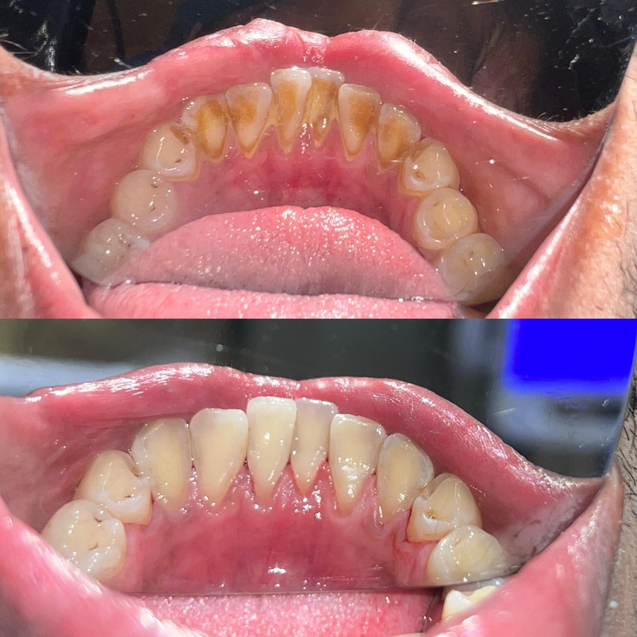 Before Teeth Scaling