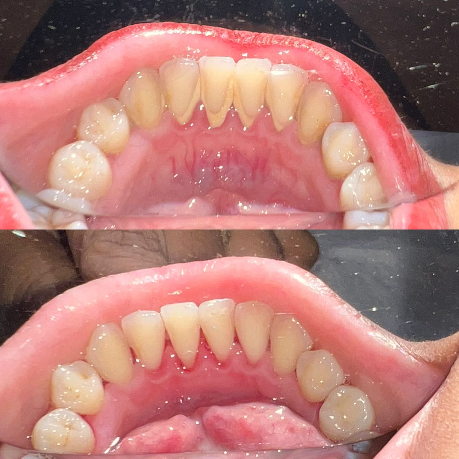 Before Orthodontic Treatment