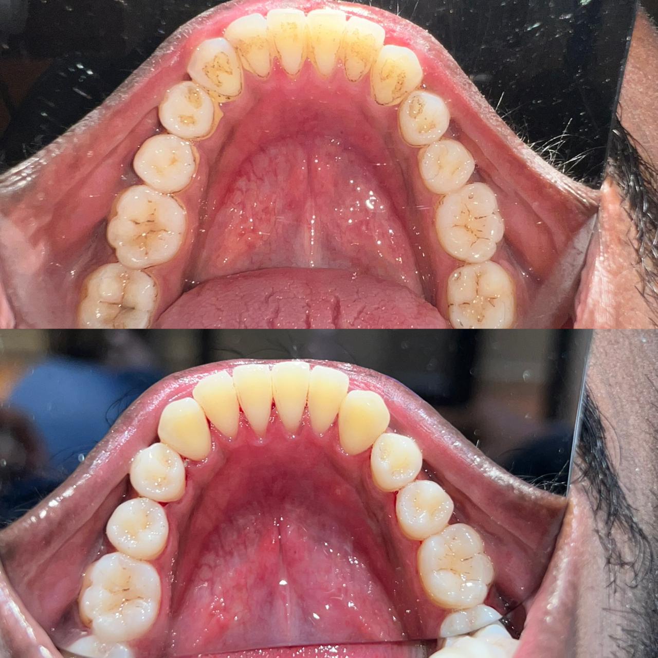 Before Teeth Whitening